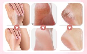 Result of using a rechargeable callus remover